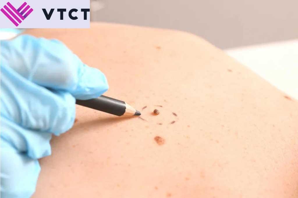 Level 4 Advanced Electrolysis Course (Skin Blemish Removal)